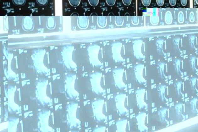 Ipofosfatemia legata all'X, primo bilancio e prospettive su linee guida