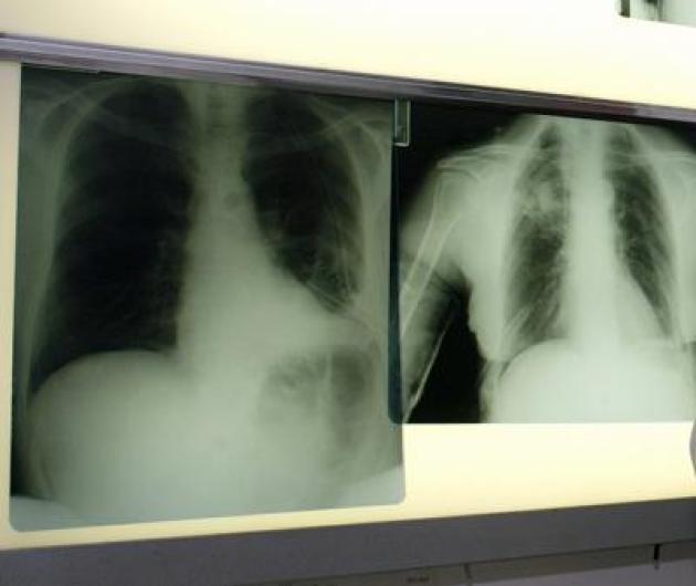 Salute, esperti: "Virus sinciziale sottovalutato nonostante oltre 50mila ricoveri l'anno"
