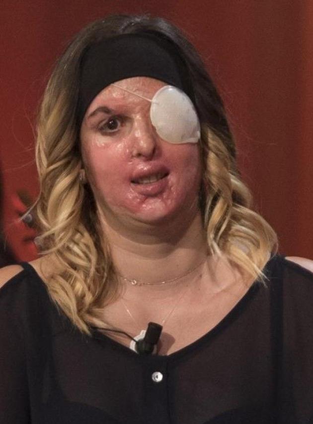 Gessica Notaro sfregiata con l'acido, condanna definitiva di 15 anni per l'ex fidanzato