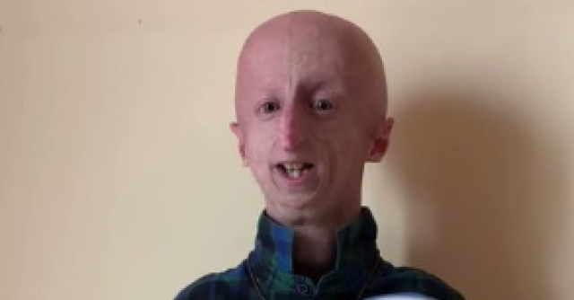 Adalia Rose morta a 15 anni: addio alla star di Youtube
