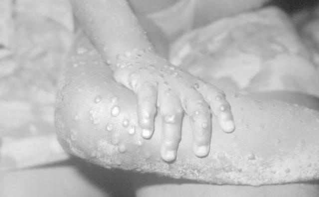 Vaiolo delle scimmie, mortalit&agrave; inferiore alla varicella. Gli esperti: "Nessuna pandemia"