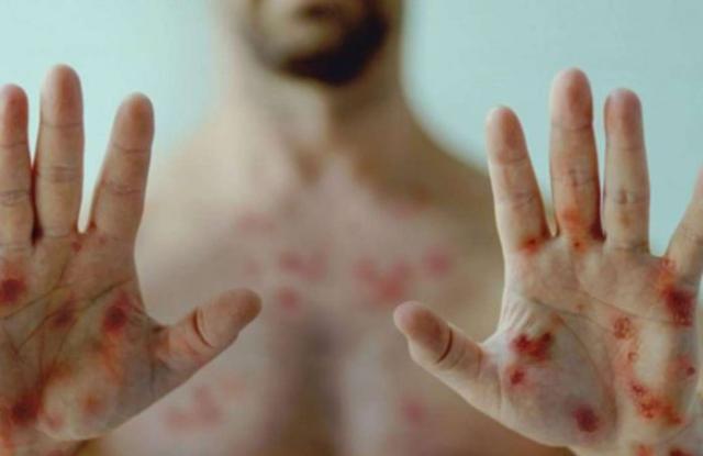 Vaiolo delle scimmie e trasmissione sessuale: perch&eacute; colpisce soprattutto gli omosessuali?