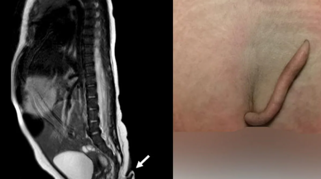 Bambina nata con una coda di 6 centimetri ricoperta di peli: "Evento rarissimo"