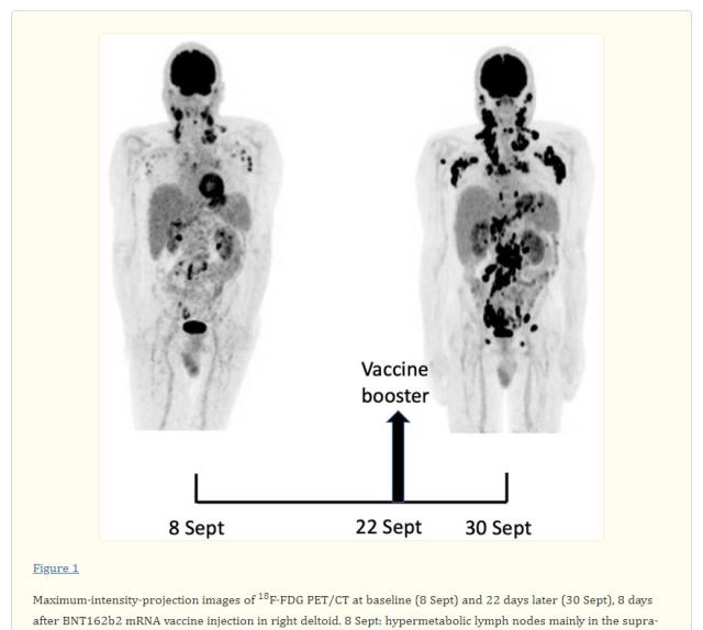 Vaccino Covid, rischio di cancro fulminante? La denuncia dell'oncologo William Makis