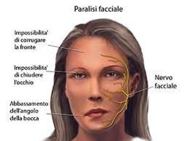 Paralisi di Bell