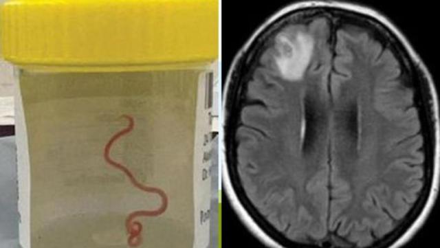 Australia, verme nel cervello di 8cm estratto da una donna, le provocava febbre e depressione, salva 64enne