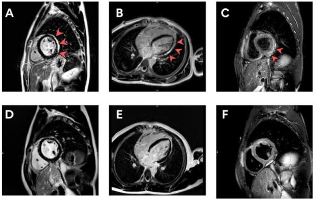 Vaccino Covid-19: "Effetti avversi per il 29,4% degli adolescenti tra i 13 e i 18 anni dopo la 2a dose" - LO STUDIO CHOC
