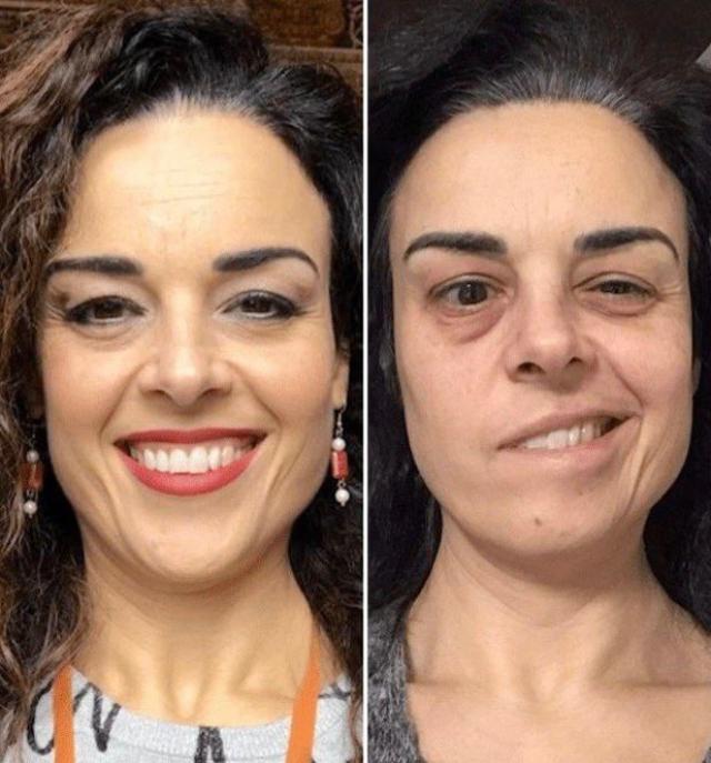 Vaccino Covid, Emilia Padovano invalida e con paralisi di Bell dopo 2 dosi Pfizer, riconosciuto nesso di causa ma nessun indennizzo dallo Stato