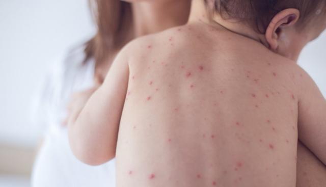 Usa, l'allarmismo sul morbillo nei bambini", 378 casi nel 2025 vs 102 del 2024 nello stesso periodo, ma su 350 mln di abitanti, Kennedy Jr: "Non &egrave; inusuale, ci sono epidemie ogni anno"