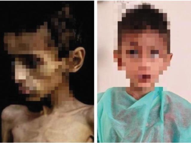 Verona, dimesso Osama Al-raqab, il bimbo di 5 anni di Gaza che pesava 9 kg, simbolo della grave malnutrizione in corso nella Striscia