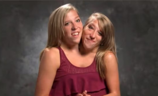 Le gemelle siamesi Abby e Brittany hanno partorito, ecco le foto con il figlio avuto da Josh: loro hanno due teste ma un unico corpo - GALLERY