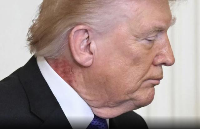 Trump con macchia rossa su collo sotto orecchio dx, ipotesi fuoco di Sant&rsquo;Antonio, medico Barbabella minimizza: &ldquo;Eruzione cutanea&rdquo;