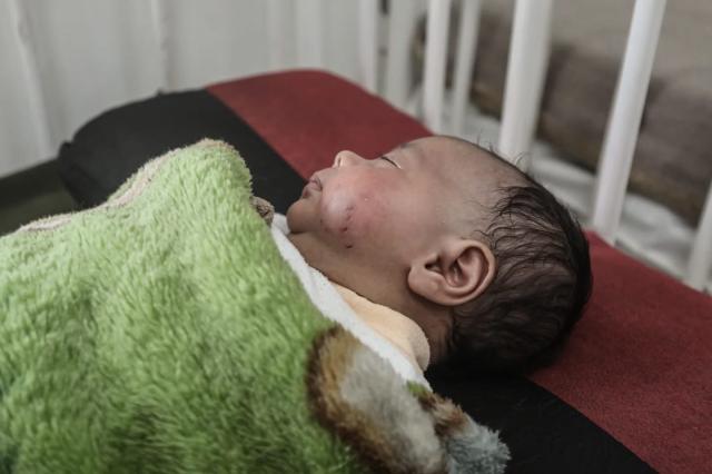 Gaza, rifugio insicuro: un morso di ratto rivela le drammatiche condizioni di vita dei bambini sfollati nella Striscia