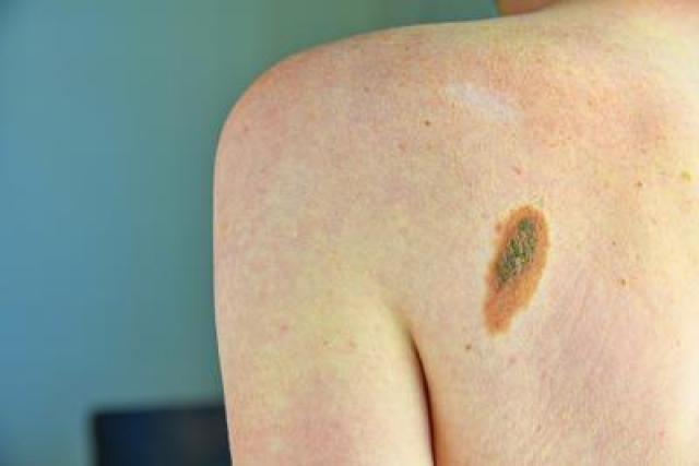 Tumori, +30% diagnosi melanoma in 2024, mai cos&igrave; tanti